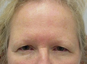 Before-Brow-Lift2