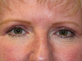 after-brow-lift
