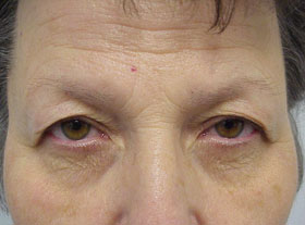 before-blephs