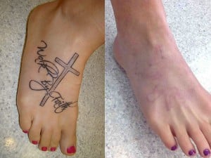 tattoo-removal-1-large